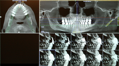 3D Röntgendiagnostik mittels Dentaler Volumentomographie (DVT)